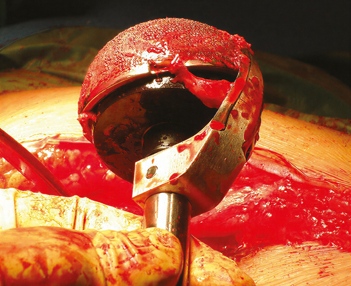 CupX - Sistema de Extração de Componente Acetabular